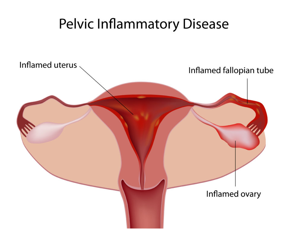 Causes Of Blocked Fallopian Tubes And Ivf Treatment 4986